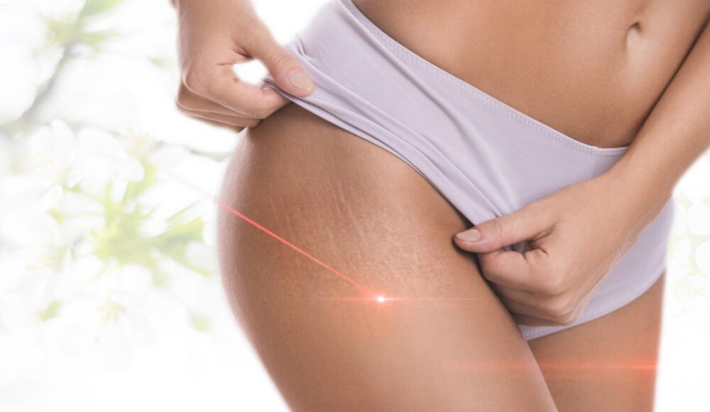 Cellulite Laser Treatment