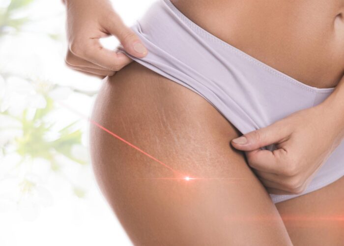 Cellulite Laser Treatment