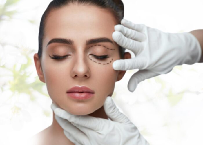 Carboxy treatment for black hollow under eyes